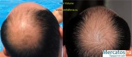 трикоксен устарел. NEW средство против выпадение волос Hairvolum