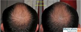 трикоксен устарел. NEW средство против выпадение волос Hairvolum 3