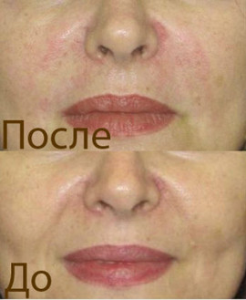 Биоревитализация, Ботекс, Мезотерапия Частный дипломированный вр 2